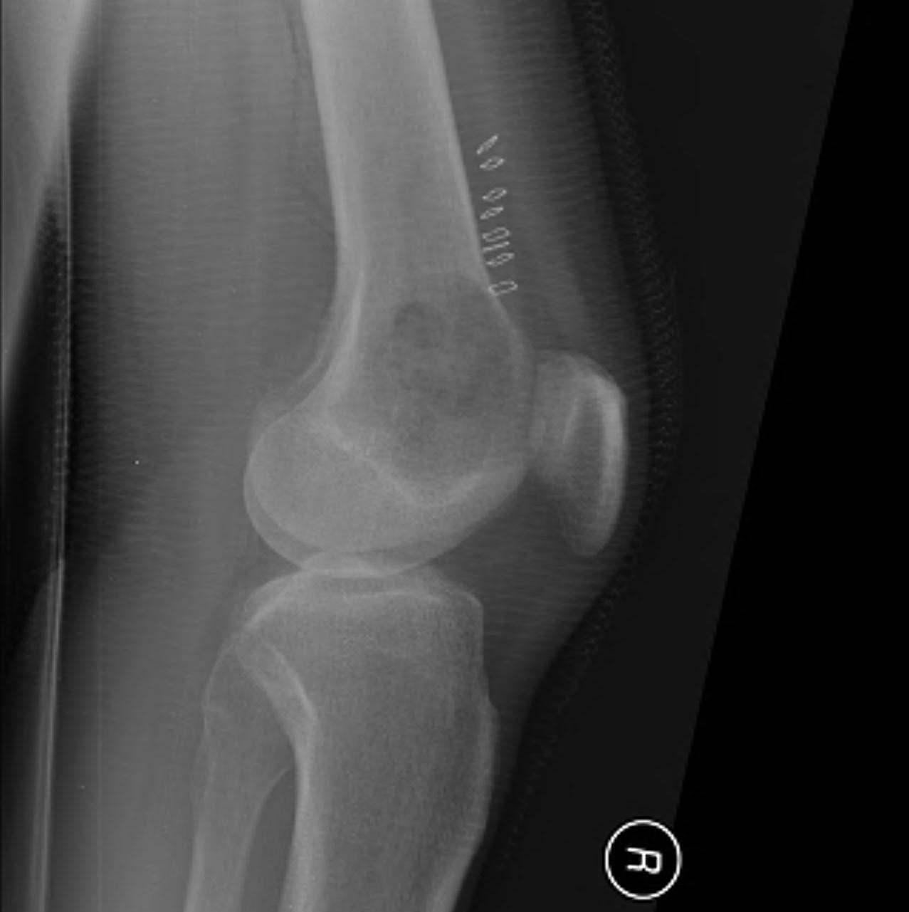 Lytic Lesion Distal Femur0002